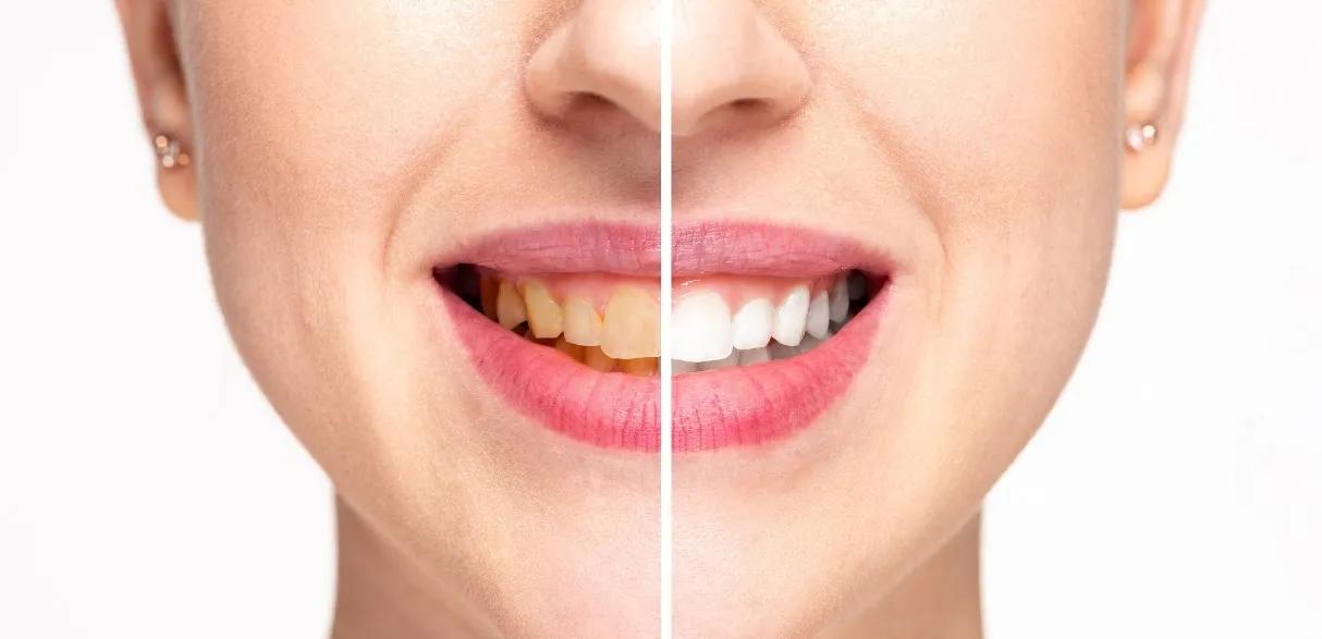 Teeth Whitening at the Dentist