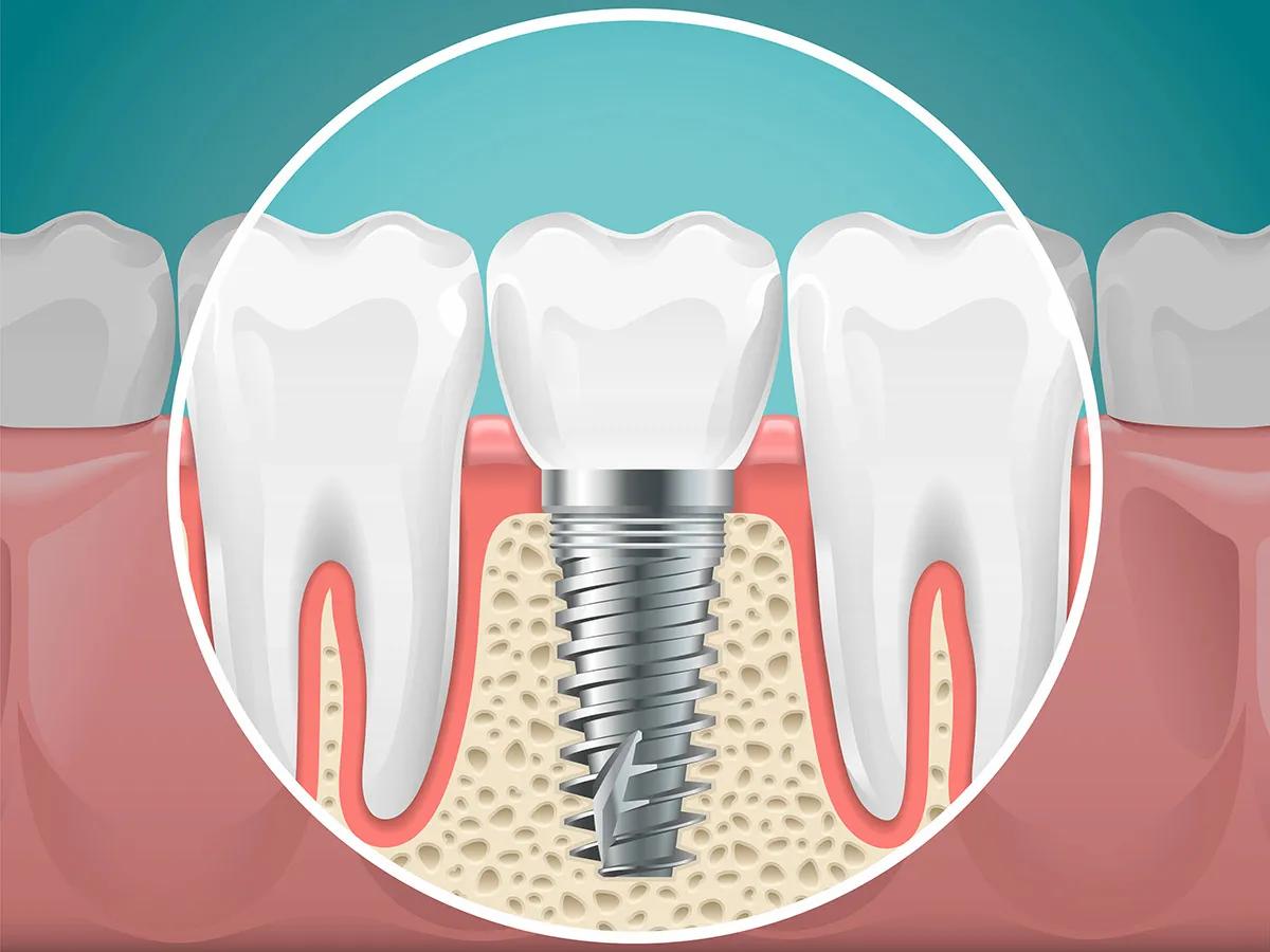 Common Myths About Dental Implants That Confuse Patients