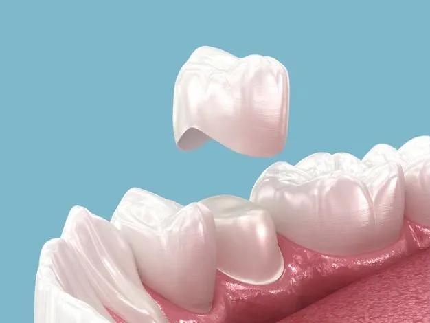 Dental Crowns vs. Bridges