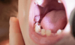 gum disease treatment
